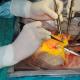 Трансплантация органов и тканей